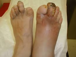 diabetic foot