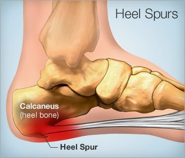 heelspur