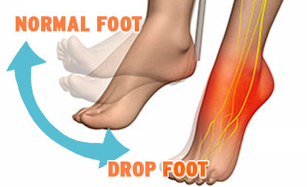 drop foot
