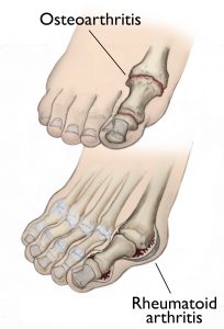 psoriatic arthritis toes