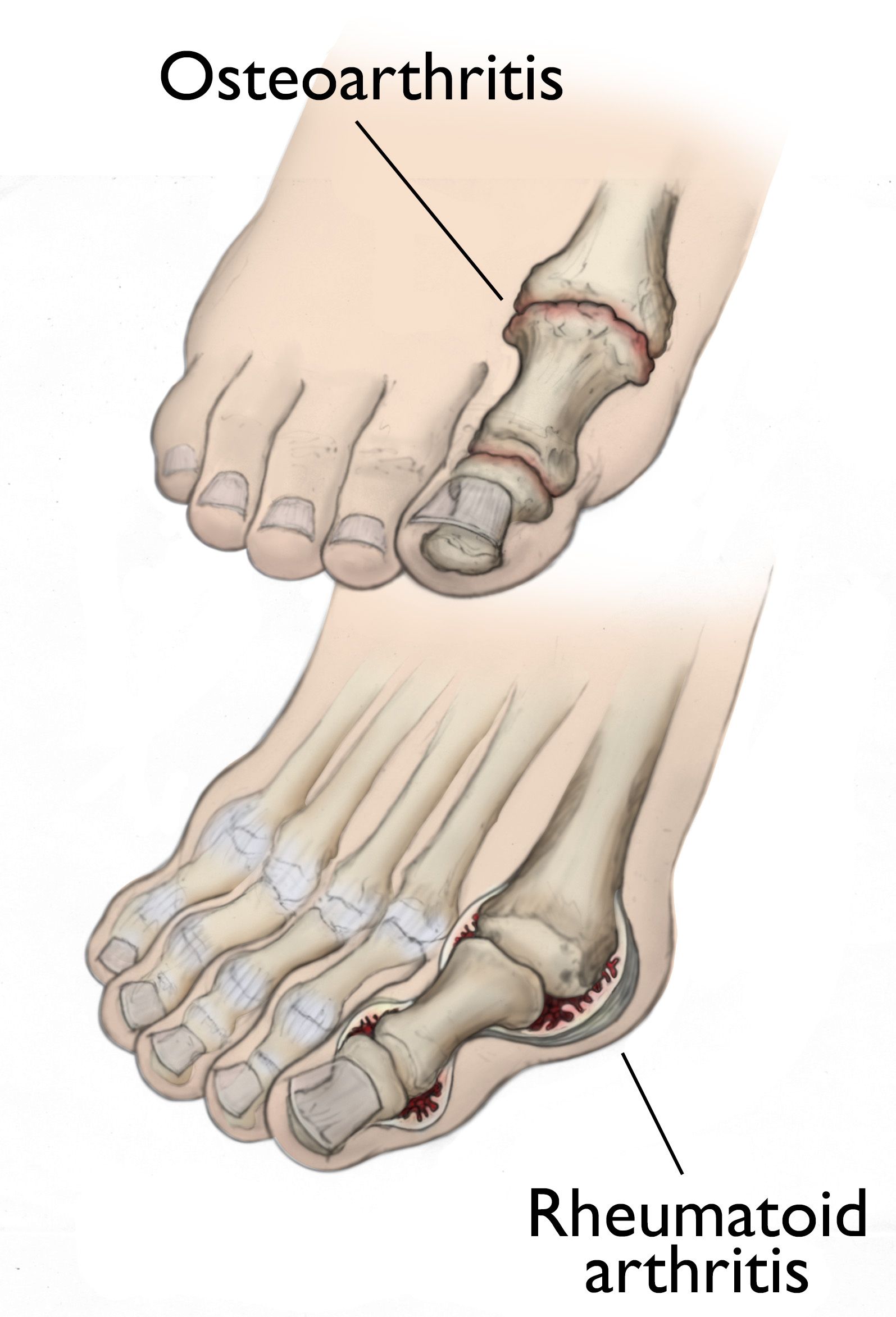 foot arthritis