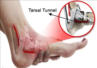 tarsal tunnel