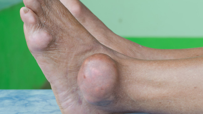 Ankle Gout