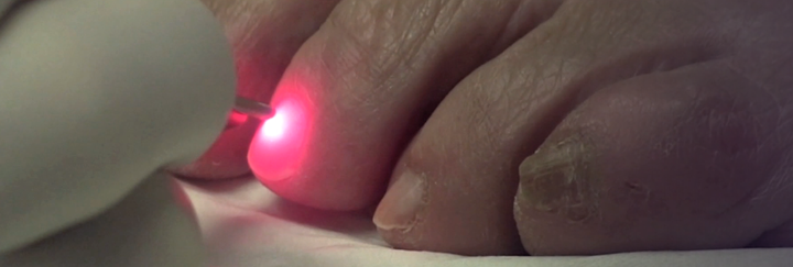 Laser toenail