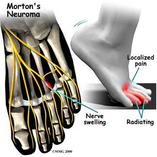 mortonNeuroma