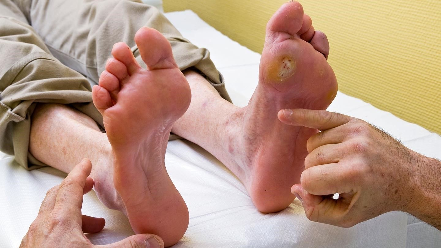 diabetic foot ulcer