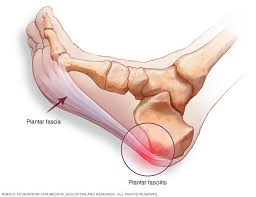 heel pain