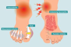 foot arthritis types