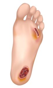 diabetic foot ulcer