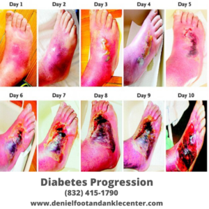 Diabetes Progression