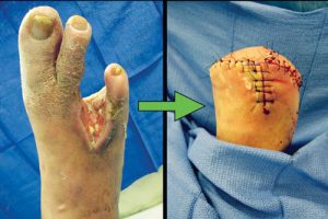 diabetic limb salvage